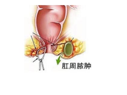 肛周膿腫最新手術(shù)方法，探索與解析